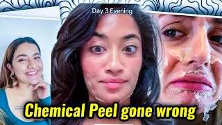 INFLUENCERS NEED TO STOP PROMITING CHEMICAL PEEL AS BEAUTY TREATMENT [upl. by Atinhoj]