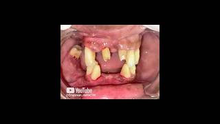 Smile transformation with fixed Teeth shorts dental viralvideo smilemakeover missingteeth [upl. by Naig702]