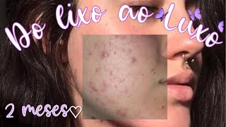 2 MESES DE TRATAMENTO COM ESPIRONOLACTONA [upl. by Mireielle454]