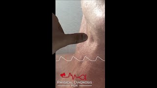 Normal Carotid Pulse Narrated [upl. by Guillermo]