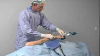 SPIDER Lateral Shoulder Procedure  SPIDER Limb Positioner  SIMON MOYES [upl. by Eiramait]