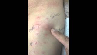 Final allergy skin test [upl. by Egan]