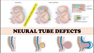 NeuraltubedefectsspinabifidameningomyelocelemeningoceleAnencephalyEncephalocele [upl. by Finbur4]