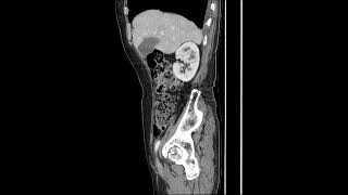 RCCrenal cell carcinoma [upl. by Wivina570]