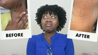 How I GOT RID OF INGROWN HAIRS amp HYPERPIGMENTATION  ESIRI [upl. by Nnaed]