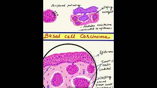 letsdrawBCC microscopymadeeasy rodent ulcer Basal Cell carcinoma step by step  DRMITHILA [upl. by Gerc]