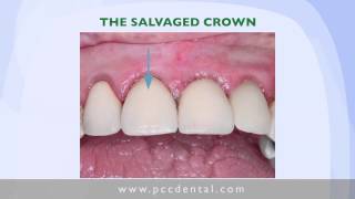 Ask Gordon Salvage of a Broken Dental Crown [upl. by Wilden]