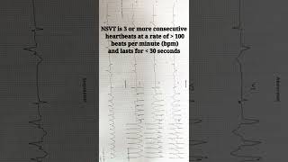 NSVT ECG interpretation made easy  Non Sustained Ventricular Tachycardia shortsfeed shorts ecg [upl. by Muhcan]