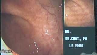 1 Minute Colonoscopy  Los Angeles Colonscopy [upl. by Savitt36]