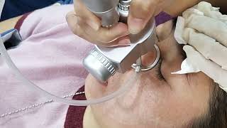 LASER CO2 FRACTIONAL TREATMENT [upl. by Macegan]