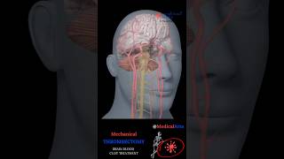 How Mechanical Thrombectomy Saves Stroke Patients Shorts [upl. by Eissirk]