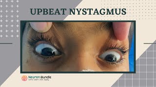 nystagmus  eye movements l demo on a patient l horizontal amp vertical nystagmus neurology [upl. by Ssilb]