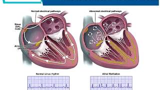 Managing Atrial Fibrillation Heart Forum Webinar  CardioSmart [upl. by Noteek]