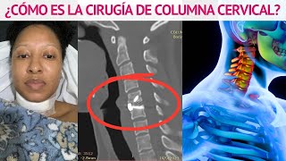 ¿CÓMO ES LA CIRUGÍA DE COLUMNA CERVICAL [upl. by Wolcott284]