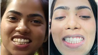 Braces removal after 3 years2021 to 2024 braces journey of dietitian kanchan rai [upl. by Aowda]