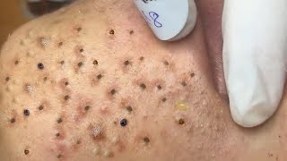 Big Cystic Acne Blackheads Extraction Blackheads amp Milia Whiteheads Removal Pimple Popping  9176 [upl. by Nahpets]