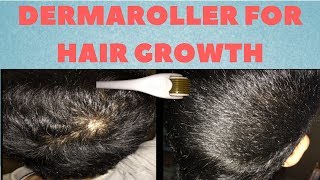 How To Regrow Hair With A Dermaroller Properly [upl. by Ellekram489]