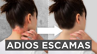 ✅ Guía Completa sobre Dermatitis Seborreica Causas Síntomas y Tratamientos Efectivos 💆🏻‍♂️ [upl. by Elspet]