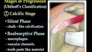 Calcific Tendonitis  Everything You Need To Know  Dr Nabil Ebraheim [upl. by Kahaleel]