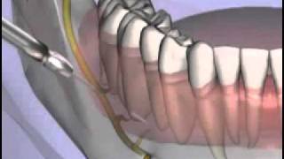 Malameds Local Anesthesia 11 Supplemental Injection Techniques [upl. by Javed83]