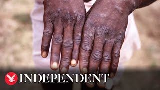 Monkeypox How does the virus spread and what are the symptoms [upl. by Sherill]