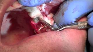 Physics Forceps Atraumatic Extraction amp Grafting for Dental Implant [upl. by Tyler]