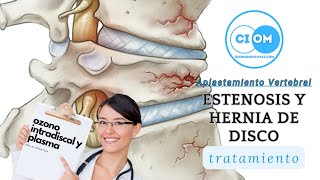 Tratamiento de Dolor lumbar por estenosis de canal y colapso vertebral [upl. by Hewie313]