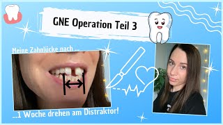 GNE Kieferoperation Bestellung der Zahnspange nach 14 Tagen Teil3 [upl. by Aeriel]