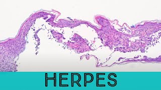 Herpes under the microscope pathology dermpath dermatology dermatopathology HSV VZV zoster [upl. by Ellivnarg157]