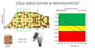 ¿Qué es una Densitometría Ósea [upl. by Kaden451]