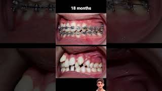 How to braces fix extremely crooked teeth braces orthodontics [upl. by Retnyw]