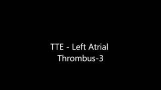 Left Atrial Thrombus  Transthoracic Echocardiogram TTE [upl. by Philo]