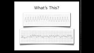 ECG Heart Rhythm Review [upl. by Okire]