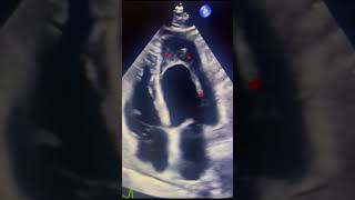 Eosinophilic myocarditis echocardiography cardiology heart clinical [upl. by Ykcor]