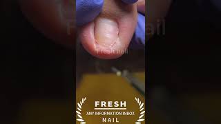 toenail fungal infection repair nailfungal toenailfungus ingrowntoenailsurgery toenails foryou [upl. by Ydnahs336]