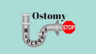 Dealing With Ostomy Blockages Ostomy Tips [upl. by Aima]