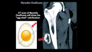 Myositis Ossificans  Everything You Need To Know  Dr Nabil Ebraheim [upl. by Airyk858]