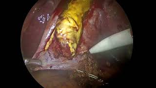 gangrene gall bladder [upl. by Pretrice]