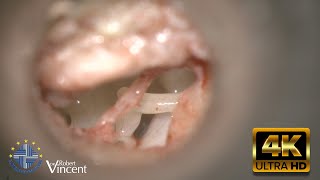 4KUHD Surgical Video Otosclerosis Primary Surgery  Stapedotomy with Vein Graft Interposition [upl. by Gilly]