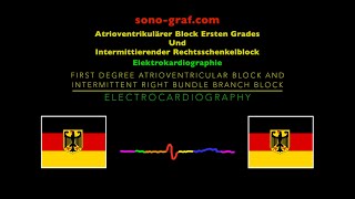 Elektrokardiographie  Atrioventrikulärer Block Ersten Grades Intermittierender Rechtsschenkelblock [upl. by Coombs]