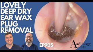 LOVELY DEEP DRY EAR WAX REMOVAL  EP905 [upl. by Suzy]