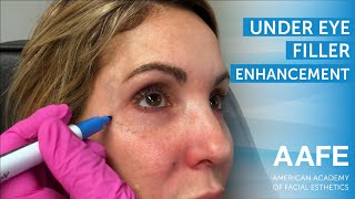 Under Eye Filler Enhancement [upl. by Hindorff]