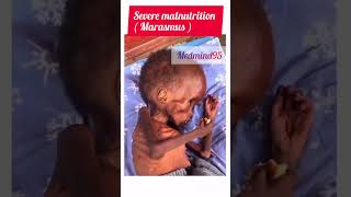 Severe malnutrition ll marasmus ll marasmus pem malnutrition baby hospital doctor surgeon mp [upl. by Shanie]