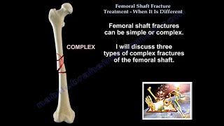 Femoral Shaft Fracture When It Is Different  Everything You Need To Know  Dr Nabil Ebraheim [upl. by Ayerf610]