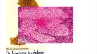 Lymphadenopathy TB vs Lymphoma [upl. by Onit]