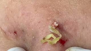 Blackheads amp Whiteheads Removal On Girls Chin 2024 Acne Treatment With Nhat Bang Channel 002 [upl. by Neelrac]