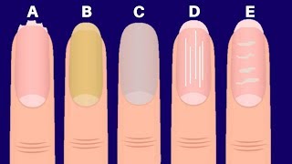 Nails Tells A Lot About Your HealthPalmistry [upl. by Eido]