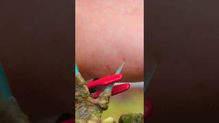 Stung by a Stonefish Most Painful Sting [upl. by Tezzil]