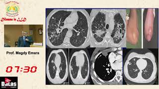 Connective Tissue Disease CTDILD  An Overview [upl. by Heyman]