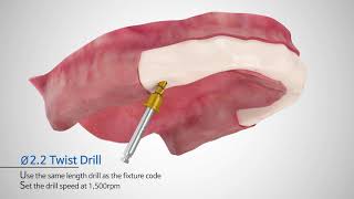 SEWONMEDIX MultiUnit Abutment Process [upl. by Harve624]